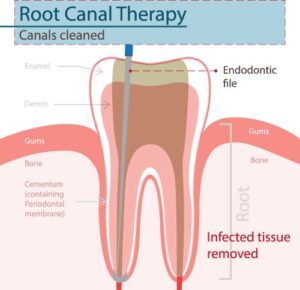 Root Canal Diagram